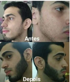 Resultado Barbudom